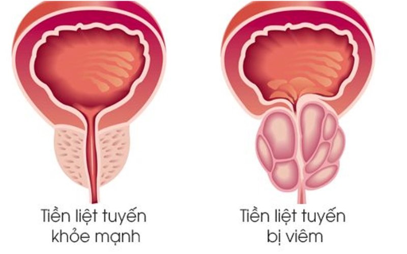 Bệnh viêm tiền liệt tuyến là gì